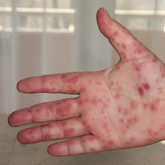 Hand Foot and Mouth Disease